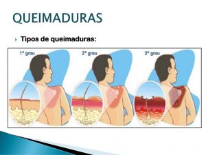 ilustração mostrando as diferenças entre queimaduras de 1º, 2º e 3º graus